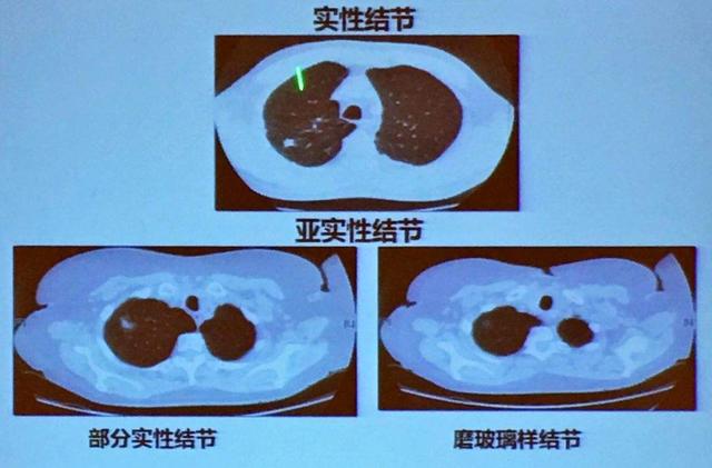打科兴疫苗后长结节现象的深度解析与科学解读